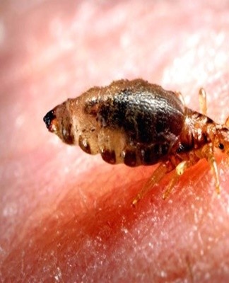 Sur le site de la piqûre de poux, un gonflement rose-rouge (papule) se forme avec du sang collé au milieu.